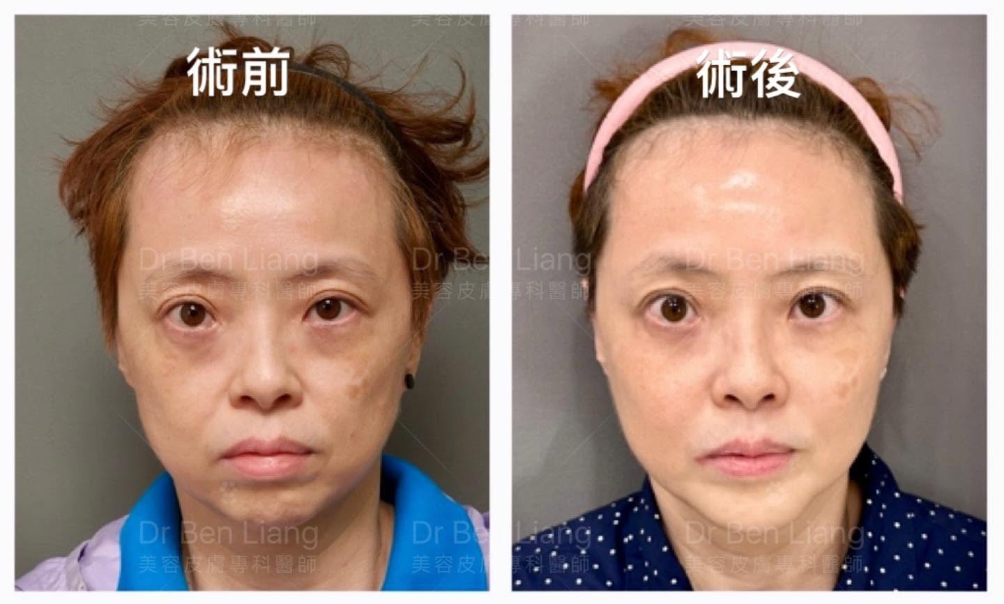 18 CC 玻尿酸臉部結構治療追蹤案例